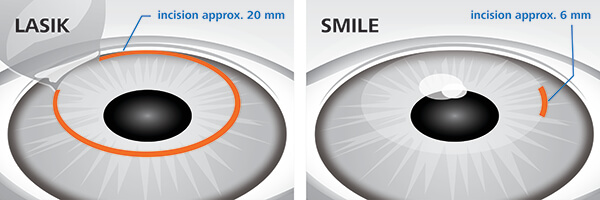 LASIK Coushatta Side by Side comparison LASIK versus SMILE