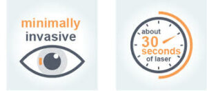 SMILE Eye Surgery Shreveport Minimally invasive SMILE eye surgery infographic