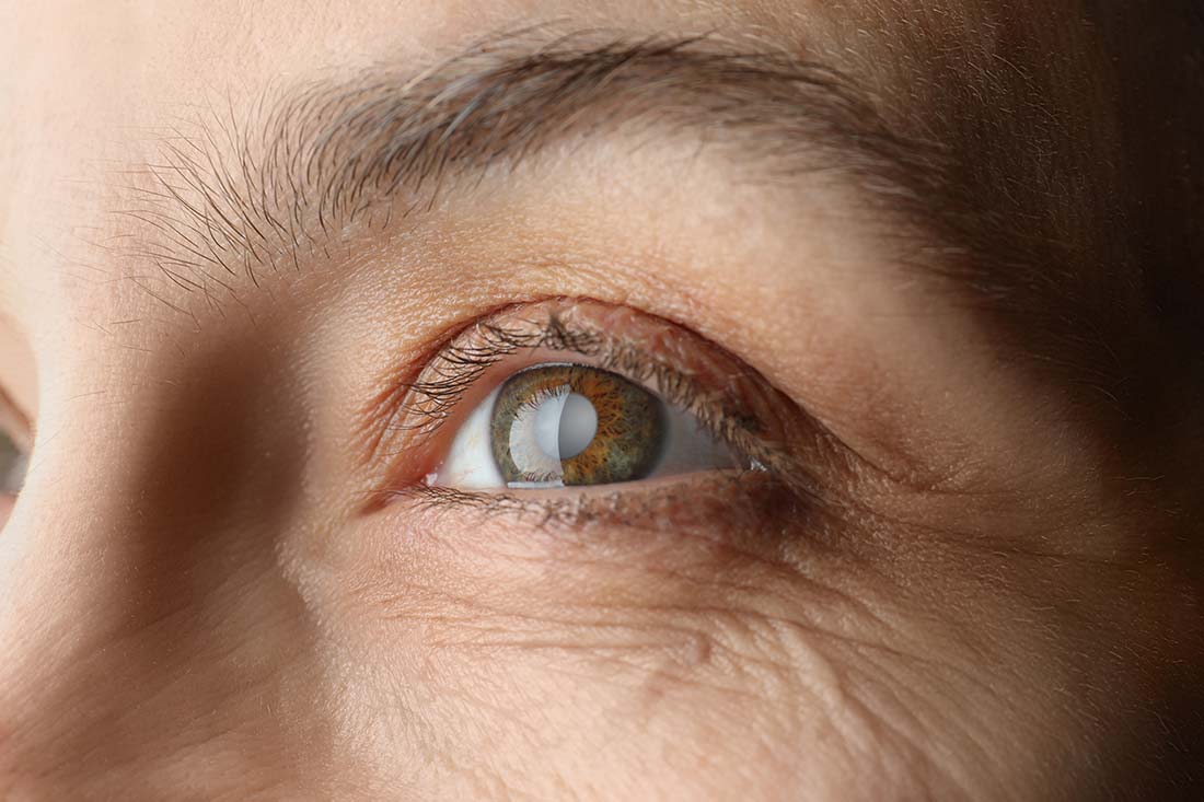 Cataract Symptoms