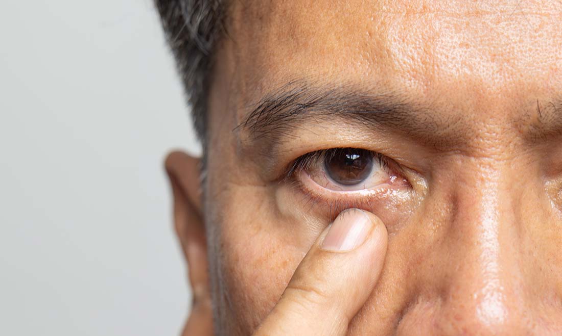 Signs of Cataracts
